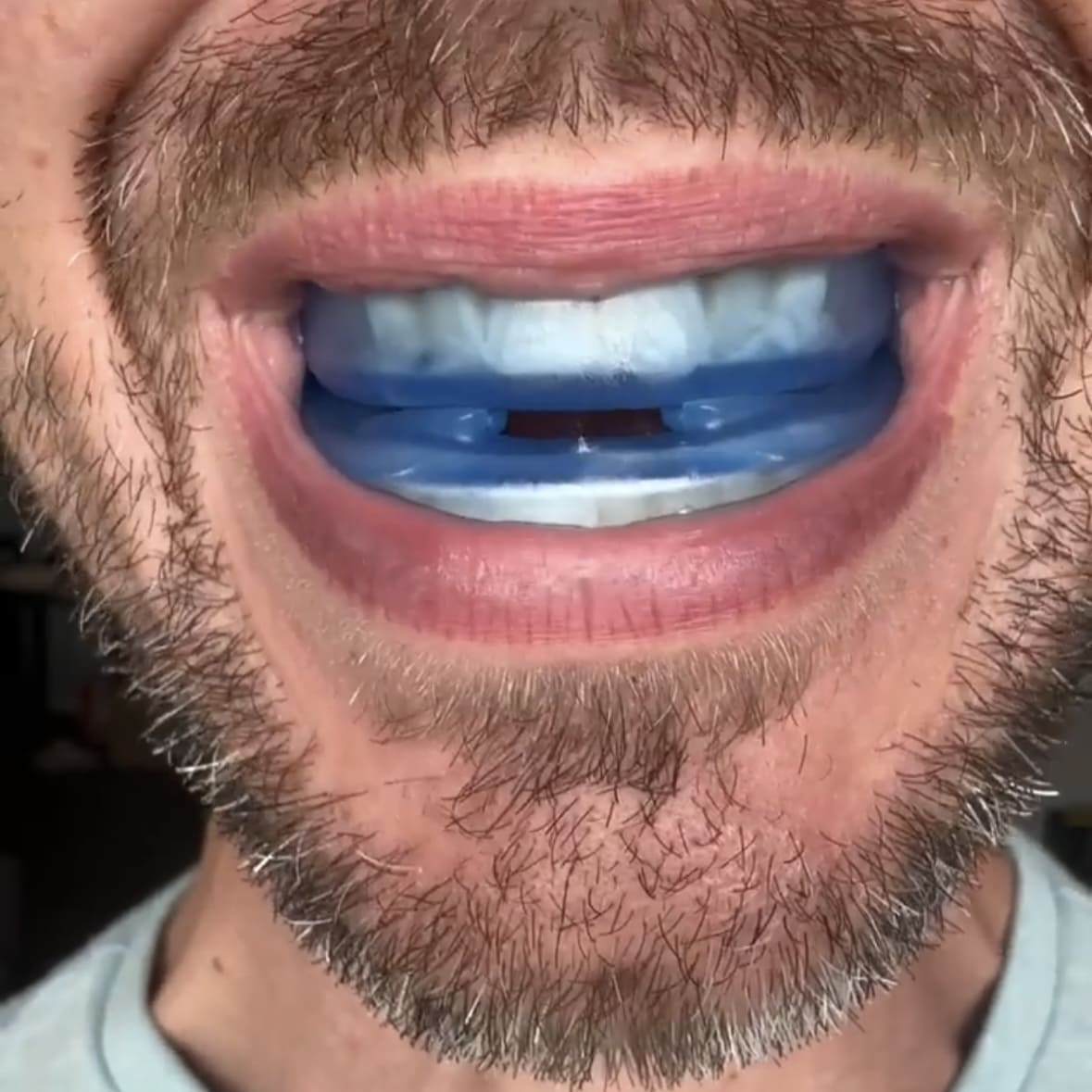 Embout buccal Anti-Ronflement Universel